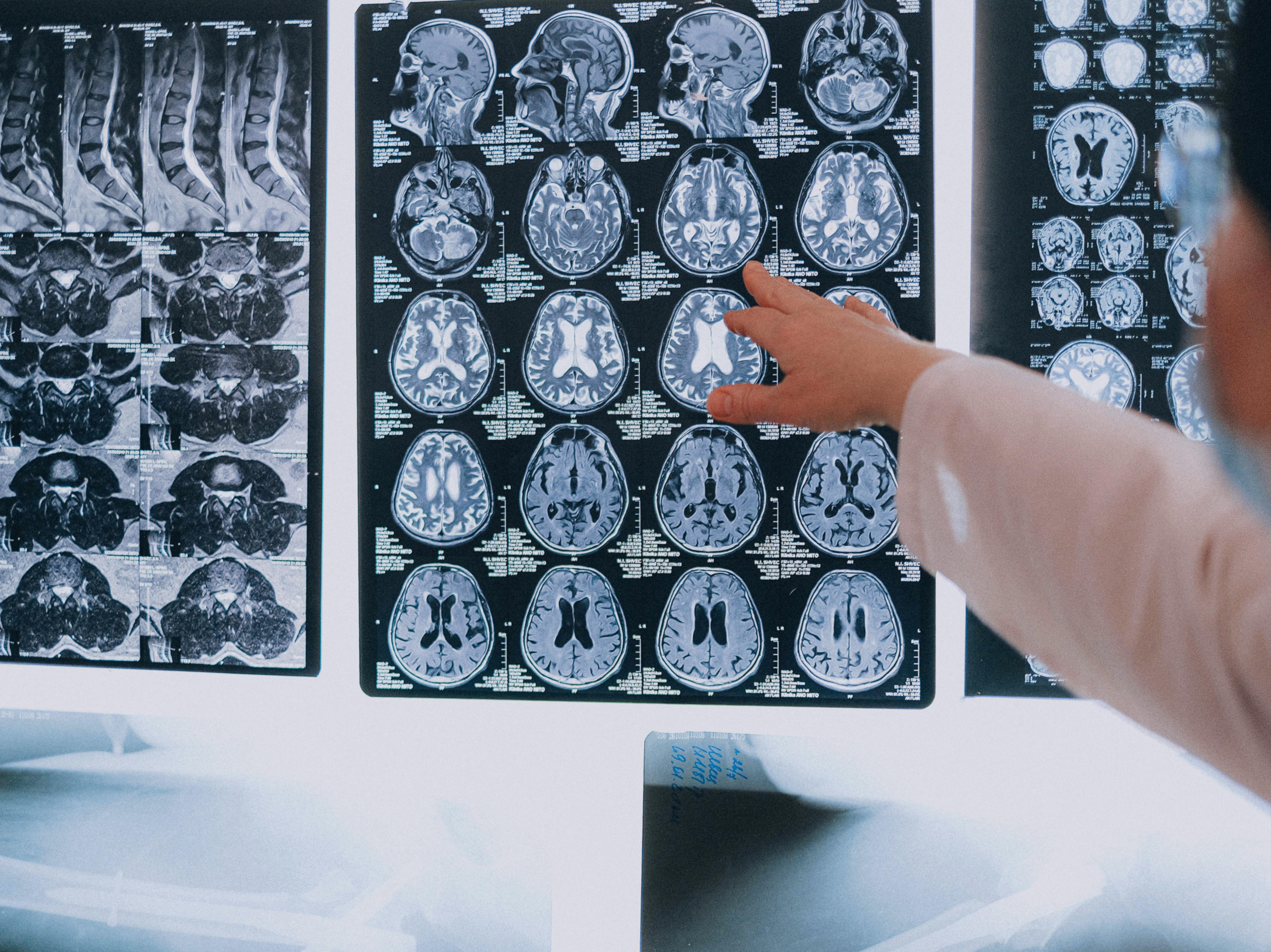 what happens during a concussion